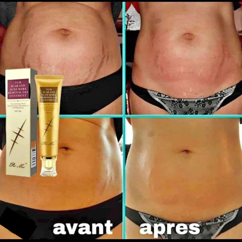 GEL REPARATRICE DE CICATRICE,VERGETURE,TACHE & ACNE TCM SCAR Pei Mei