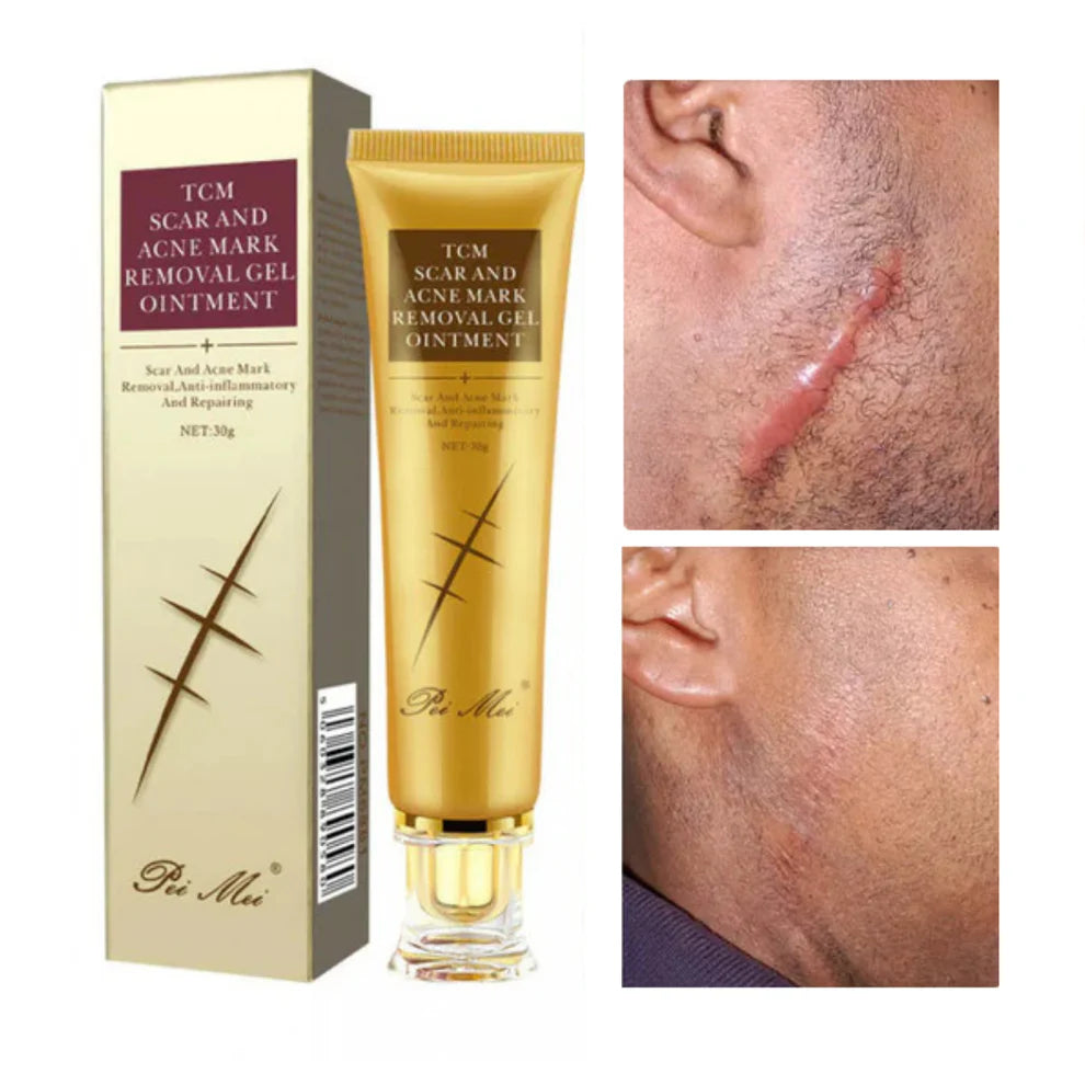 GEL REPARATRICE DE CICATRICE,VERGETURE,TACHE & ACNE TCM SCAR Pei Mei